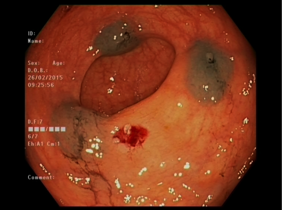 File:Adenocarcioma of rectum- T1 lesion (Radiopaedia 36921-38553 A 4).png