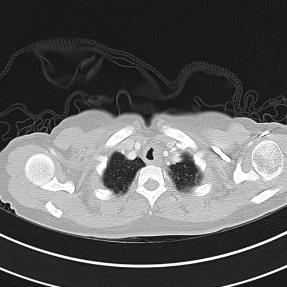 Adenocystic carcinoma of the trachea (Radiopaedia 47677-52525 Axial lung window 31).jpg