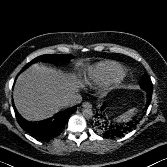 File:Adenoid cystic carcinoma of the trachea (Radiopaedia 49042-54137 Axial non-contrast 277).jpg