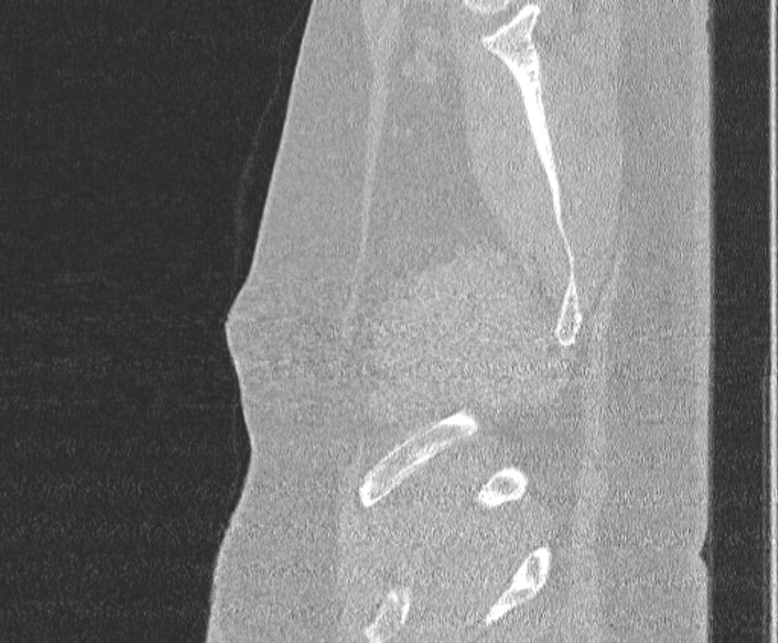 Adenoid cystic carcinoma of the trachea (Radiopaedia 49042-54137 Sagittal lung window 23).jpg