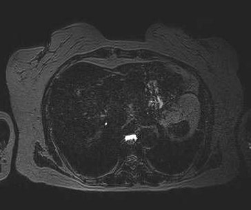 File:Adenomyomatosis of the gallbladder (Radiopaedia 50246-55587 Axial 2).png