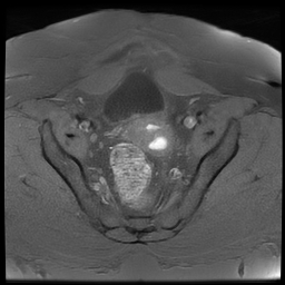 File:Adenomyosis within a didelphys uterus (Radiopaedia 70175-80215 Axial T1 fat sat 25).jpg