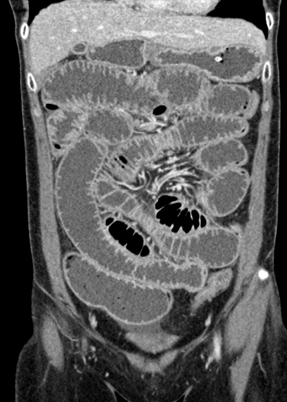 Adhesional small bowel obstruction (Radiopaedia 48397-53305 Coronal C+ portal venous phase 112).jpg