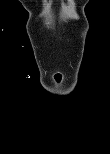 Adhesional small bowel obstruction (Radiopaedia 48397-53305 Coronal C+ portal venous phase 18).jpg
