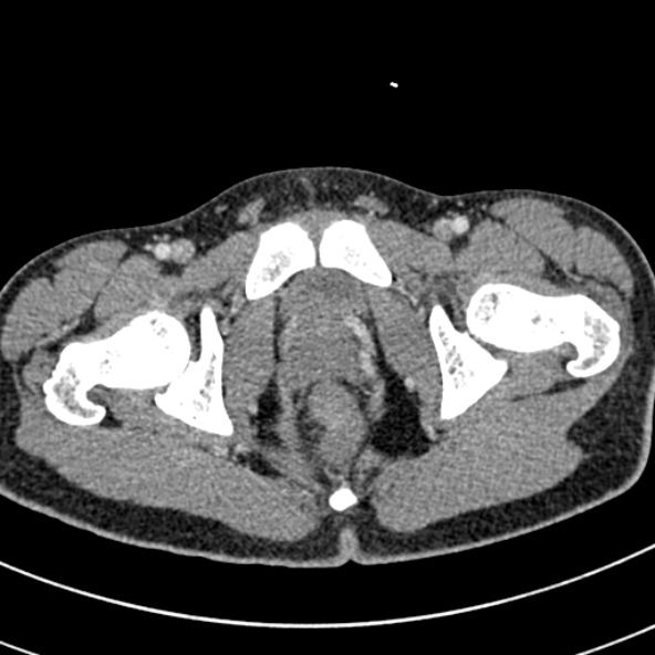 File:Adhesional small bowel obstruction (Radiopaedia 52107-57980 Axial C+ portal venous phase 126).jpg
