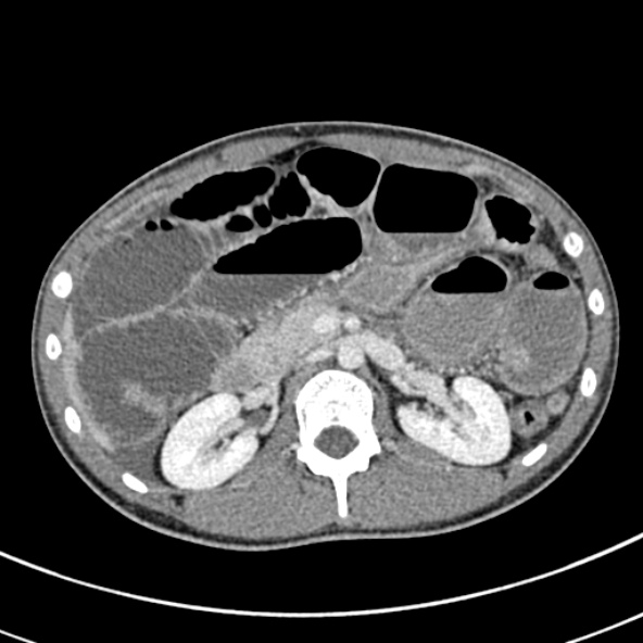 Adhesional small bowel obstruction (Radiopaedia 52107-57980 Axial C+ portal venous phase 41).jpg