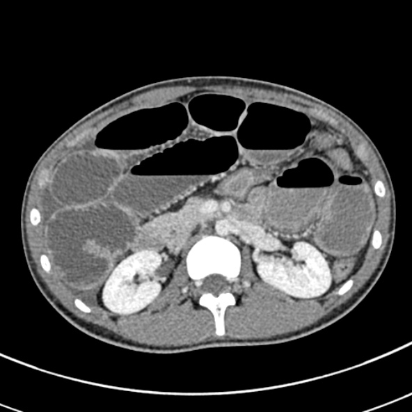 Adhesional small bowel obstruction (Radiopaedia 52107-57980 Axial C+ portal venous phase 43).jpg