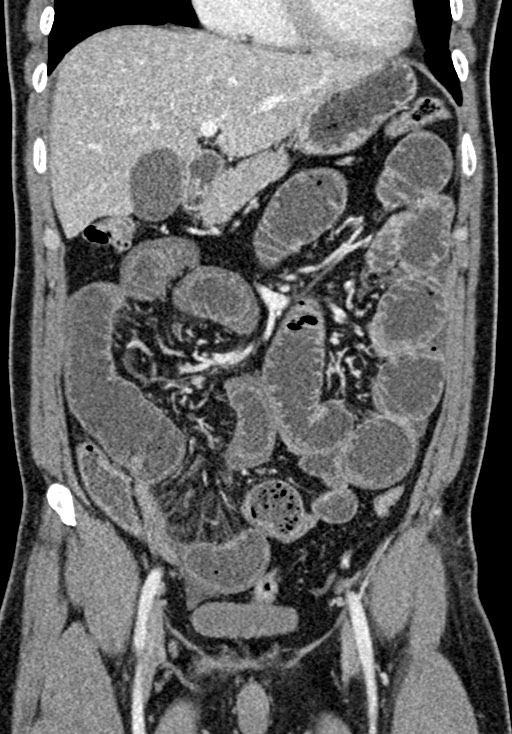 Adhesional small bowel obstruction (Radiopaedia 58900-66131 Coronal C+ portal venous phase 113).jpg