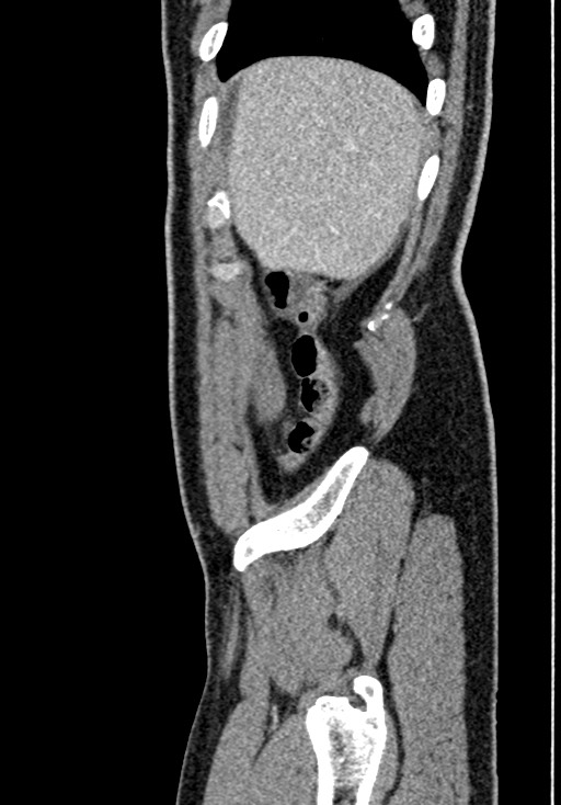 Adhesional small bowel obstruction (Radiopaedia 58900-66131 Sagittal C+ portal venous phase 31).jpg