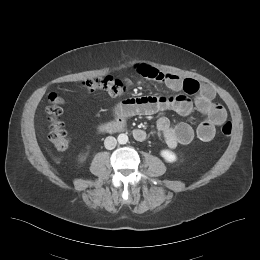 File:Adhesions within abdominal wall hernia (Radiopaedia 58283-65394 Axial C+ portal venous phase 45).png