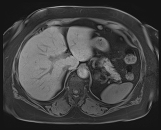 Adrenal cortical carcinoma (Radiopaedia 64017-72770 Axial T1 fat sat 18).jpg