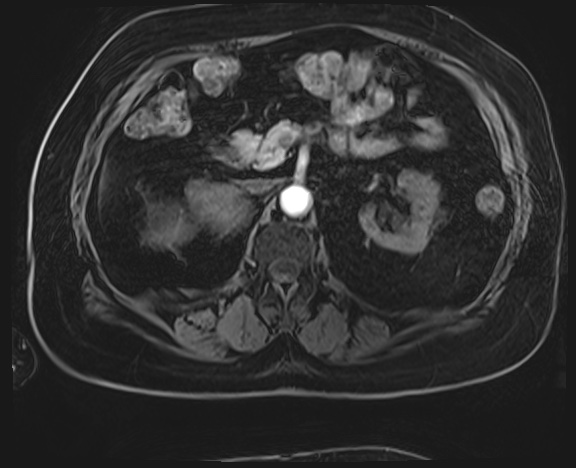 Adrenal cortical carcinoma (Radiopaedia 64017-72770 H 18).jpg