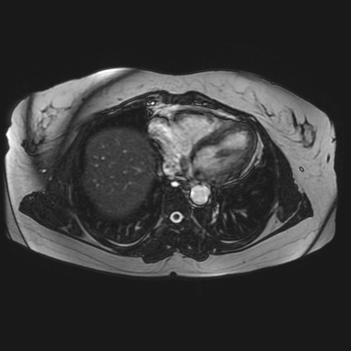 File:Adrenal cortical carcinoma (Radiopaedia 70906-81116 Axial FIESTA 1).jpg