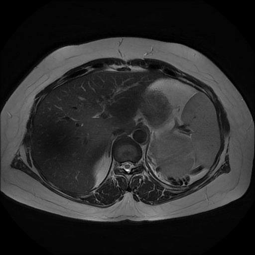 File:Adrenal cortical carcinoma (Radiopaedia 70906-81116 Axial T2 8).jpg