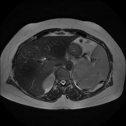 File:Adrenal cortical carcinoma (Radiopaedia 70906-81116 Axial T2 9).jpg