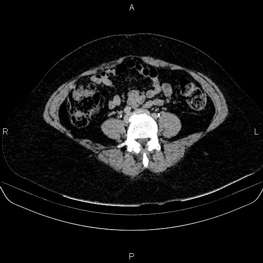 Adrenal cortical carcinoma (Radiopaedia 84882-100379 Axial C+ delayed 60).jpg