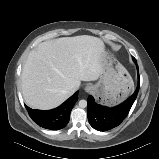File:Adrenal cyst (Radiopaedia 45625-49777 Axial C+ portal venous phase 20).png