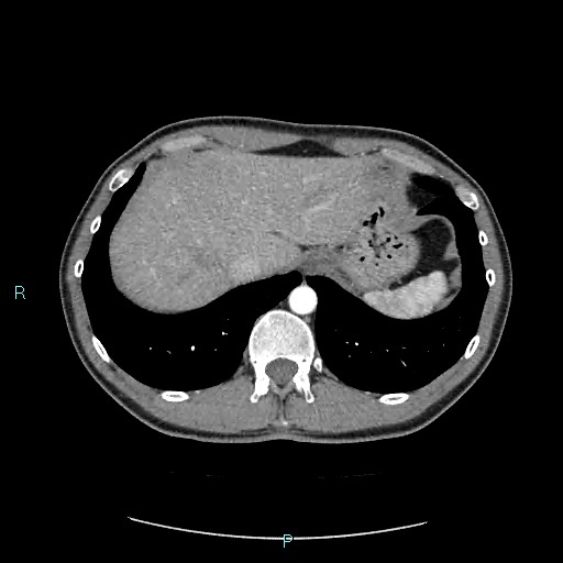 Adrenal cystic lymphangioma (Radiopaedia 83161-97534 Axial C+ arterial phase 17).jpg
