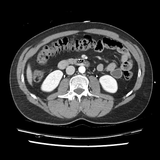 Adrenal gland trauma (Radiopaedia 81351-95078 Axial Dual bolus trauma C+ 77).jpg
