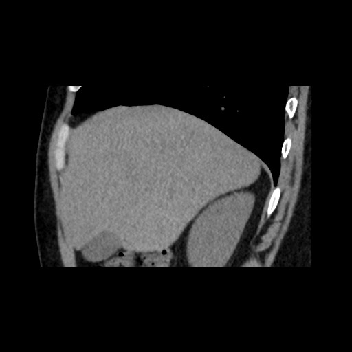 Adrenal gland trauma (Radiopaedia 81351-95079 Sagittal non-contrast 23).jpg