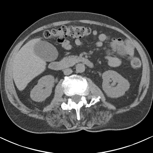 File:Adrenal hematoma (Radiopaedia 44334-47967 Axial non-contrast 46).png