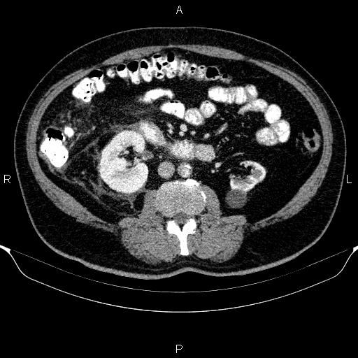 Adrenal hemorrhage (Radiopaedia 62622-70916 Axial C+ portal venous phase 94).jpg