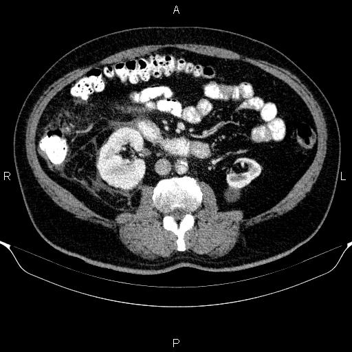 Adrenal hemorrhage (Radiopaedia 62622-70916 Axial C+ portal venous phase 95).jpg