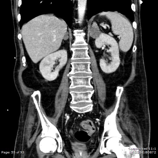 File:Adrenal metastasis (Radiopaedia 78425-91079 Sagittal C+ portal venous phase 42).jpg