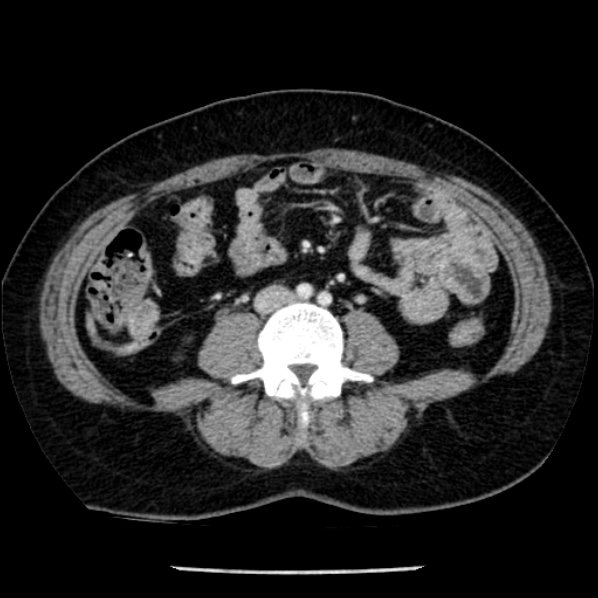 Adrenal myelolipoma (Radiopaedia 43401-46759 Axial C+ portal venous phase 50).jpg