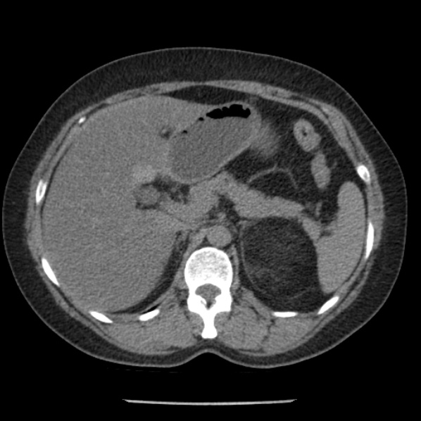 Adrenal myelolipoma (Radiopaedia 43401-46759 Axial non-contrast 26).jpg