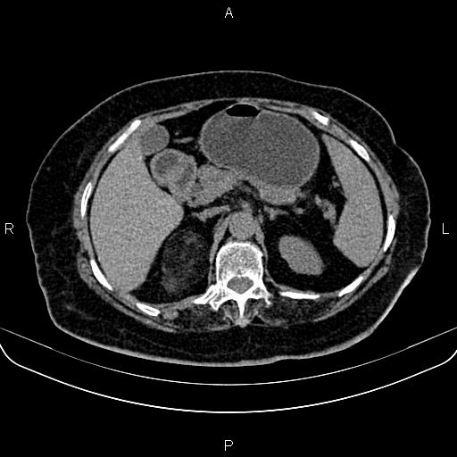 Adrenal myelolipoma (Radiopaedia 82742-96986 Axial non-contrast 45).jpg