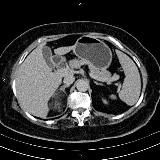 Adrenal myelolipoma (Radiopaedia 82742-96986 Axial renal excretory phase 35).jpg