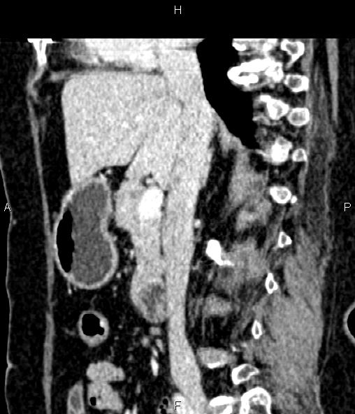 File:Adrenal myelolipoma (Radiopaedia 82742-96986 Sagittal renal cortical phase 50).jpg
