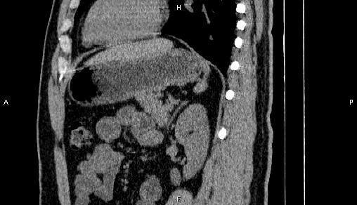 Adrenal myelolipoma (Radiopaedia 84321-99619 Sagittal non-contrast 73).jpg