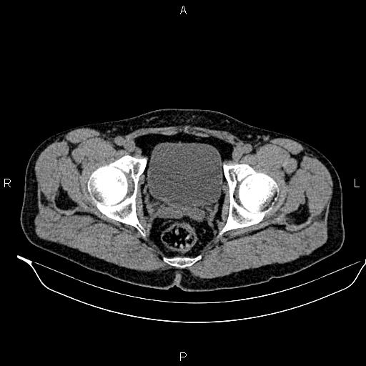 Adrenal myelolipoma (Radiopaedia 87794-104246 Axial non-contrast 101).jpg