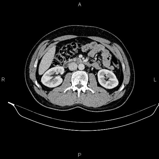 Adrenal myelolipoma (Radiopaedia 87794-104246 Axial renal cortical phase 48).jpg