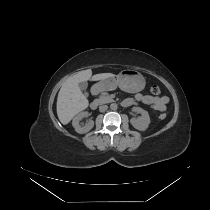 Adrenal myelolipoma - MRI (Radiopaedia 83249-97647 Axial non-contrast 62).jpg