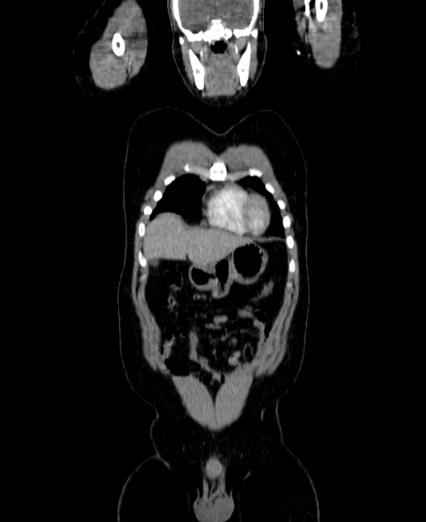 Adrenocortical carcinoma (Radiopaedia 80134-93438 Coronal C+ portal venous phase 37).jpg