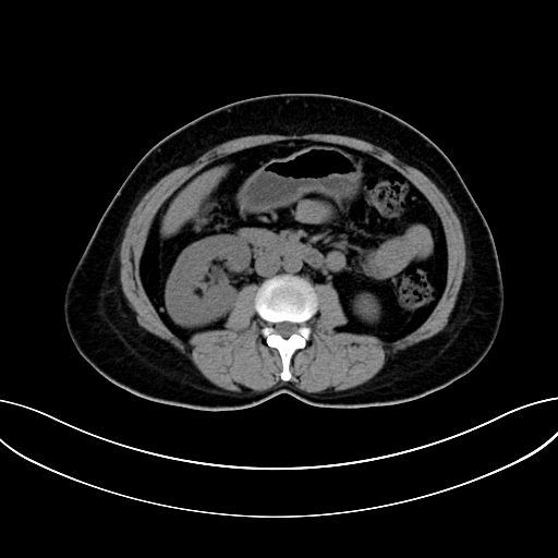 Adrenocortical carcinoma (Radiopaedia 87281-103569 Axial non-contrast 43).jpg