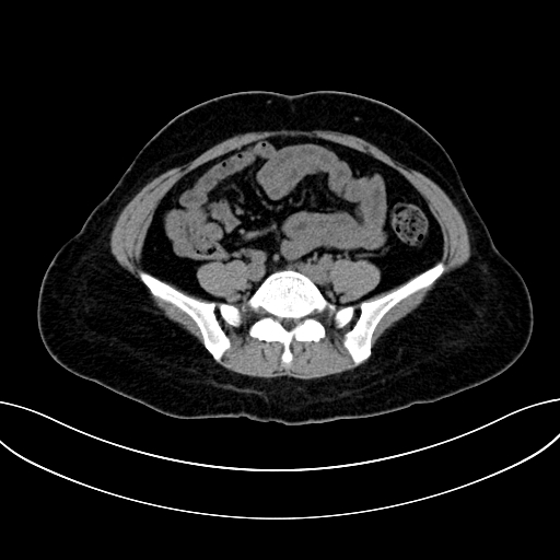 Adrenocortical carcinoma (Radiopaedia 87281-103569 Axial non-contrast 60).jpg