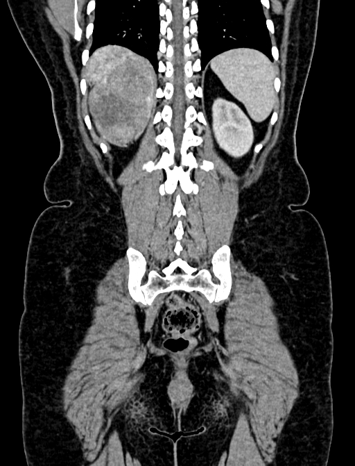 Adrenocortical carcinoma (Radiopaedia 87281-103569 Coronal C+ portal venous phase 118).jpg