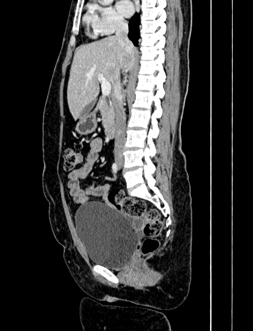 Adrenocortical carcinoma (Radiopaedia 87281-103569 Sagittal C+ portal venous phase 136).jpg