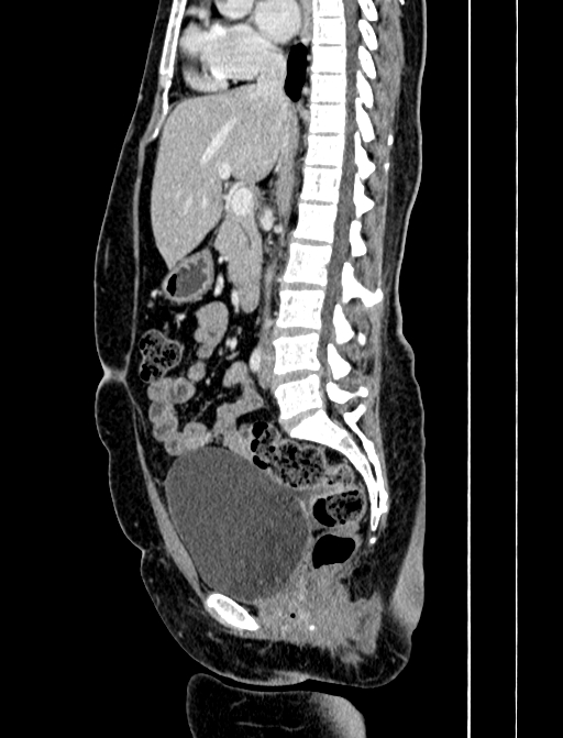 Adrenocortical carcinoma (Radiopaedia 87281-103569 Sagittal C+ portal venous phase 143).jpg