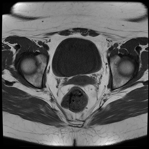 File:Adult granulosa cell tumor of the ovary (Radiopaedia 64991-73953 Axial T1 17).jpg