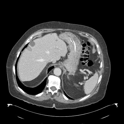 Adult ileal intussusception with secondary obstruction (Radiopaedia 30395-31051 Axial C+ portal venous phase 13).jpg