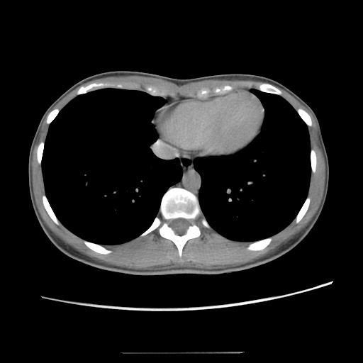 Adult polycystic kidney disease (Radiopaedia 48845-53876 Axial renal excretory phase 11).jpg