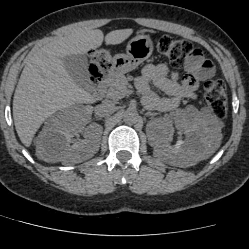 Adult polycystic kidney disease (Radiopaedia 59075-66368 Axial non-contrast 22).jpg