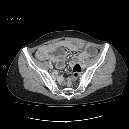 Adult transient intestinal intussusception (Radiopaedia 34853-36310 Axial C+ portal venous phase 87).jpg