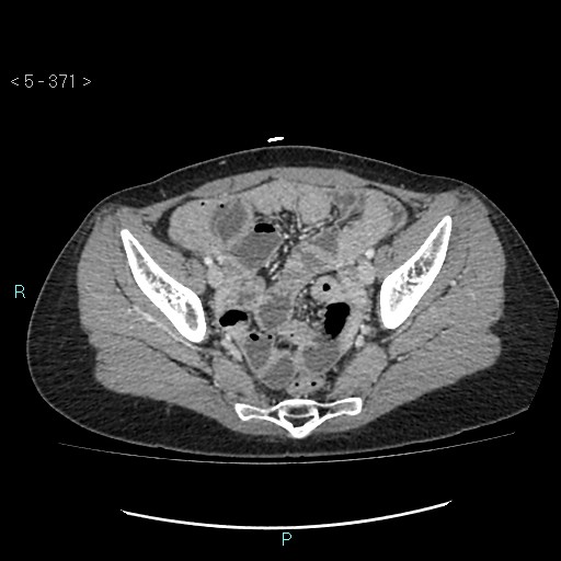 Adult transient intestinal intussusception (Radiopaedia 34853-36310 Axial C+ portal venous phase 93).jpg