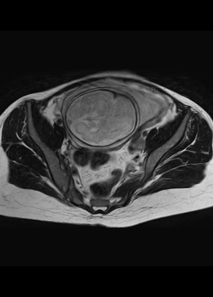 File:Aggressive angiomyxoma of the pelvis and perineum (Radiopaedia 59162-66479 Axial T2 17).jpg